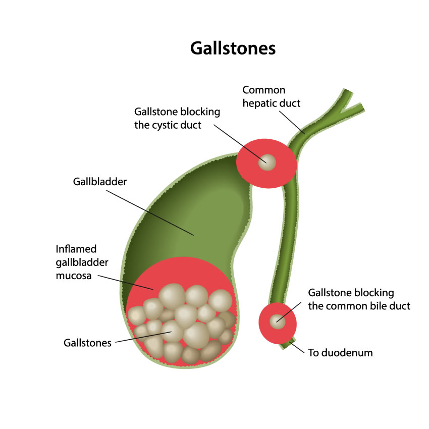 Gallstones Symptoms Causes And Treatment KYM Gall Bladder Surgery